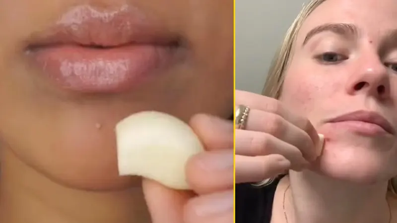 Youth, Trending, Garlic for acne, Home remedies, Skincare hacks, Social Media trends, Garlic face rubbing, Garlic face rubbing Trend, Garlic face rubbing Instagram Trend, Garlic face rubbing TikTok Trend, Beauty Influencer Garlic face rubbing trend- True Scoop