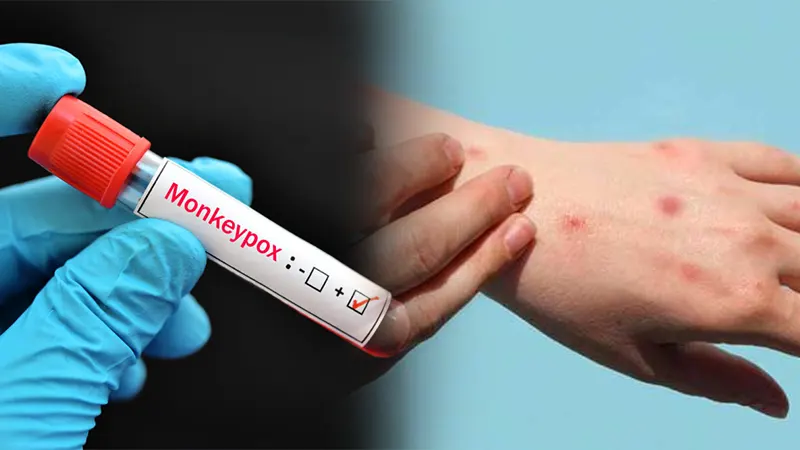 India, Trending, Mpox in India, Monkeypox in India, Monkeypox Indian Patient, Monkeypox patient India, How to prevent MPox Infection, Mpox Prevention, What is Mpox, Monkey Pox India Patient History- True Scoop