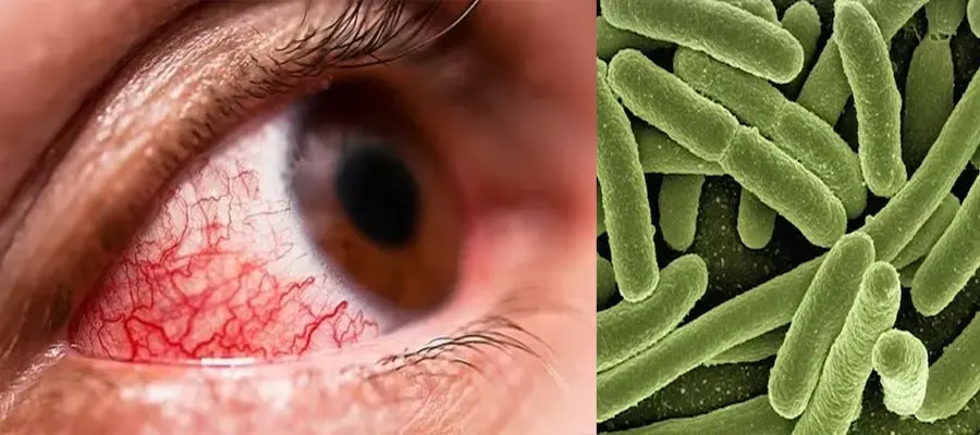 Trending, What is bleeding eye virus, bleeding eye virus symptoms, bleeding eye virus treatment, bleeding eye virus, bleeding eye virus infection, bleeding eye virus Rwanda, bleeding eye virus WHO, bleeding eye virus disease, bleeding eye virus precaution- True Scoop